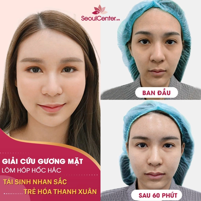 Khám phá quy trình cấy collagen đa nguyên bào tại seoul center - 3