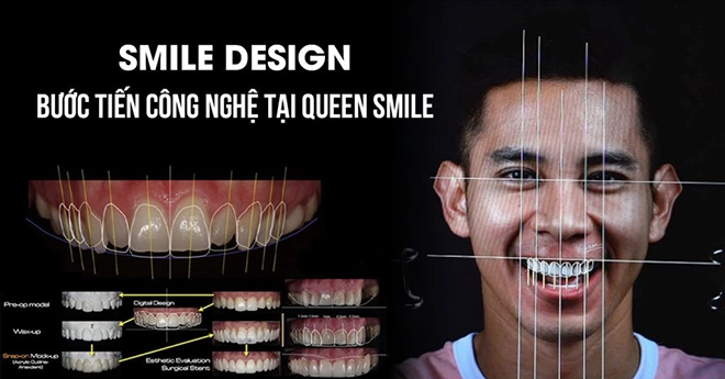 Thiết kế nụ cười bước tiến công nghệ tại queen smile - 1