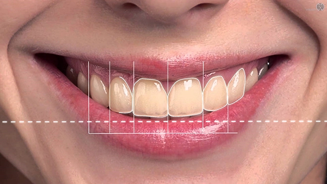 Thiết kế nụ cười bước tiến công nghệ tại queen smile - 3