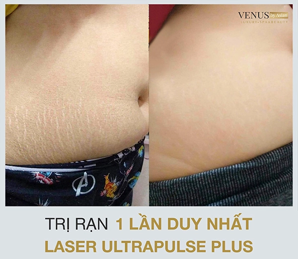 U30 40 tự tin chia sẻ bí quyết trị rạn da sau sinh - 1