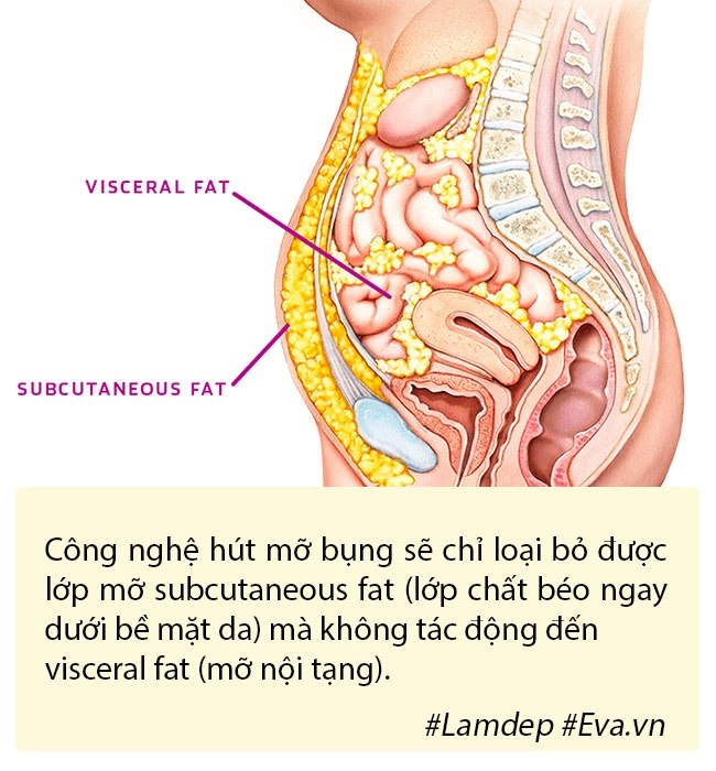 Hút mỡ tạo hình thành bụng bí quyết vàng cho hội chị em nghiện diện bikini - 2