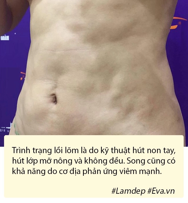 Hút mỡ tạo hình thành bụng bí quyết vàng cho hội chị em nghiện diện bikini - 6