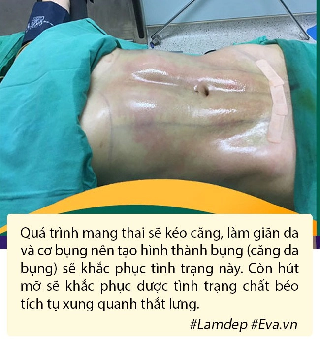 Hút mỡ tạo hình thành bụng bí quyết vàng cho hội chị em nghiện diện bikini - 7