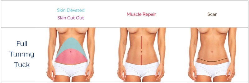 Hút mỡ tạo hình thành bụng bí quyết vàng cho hội chị em nghiện diện bikini - 8