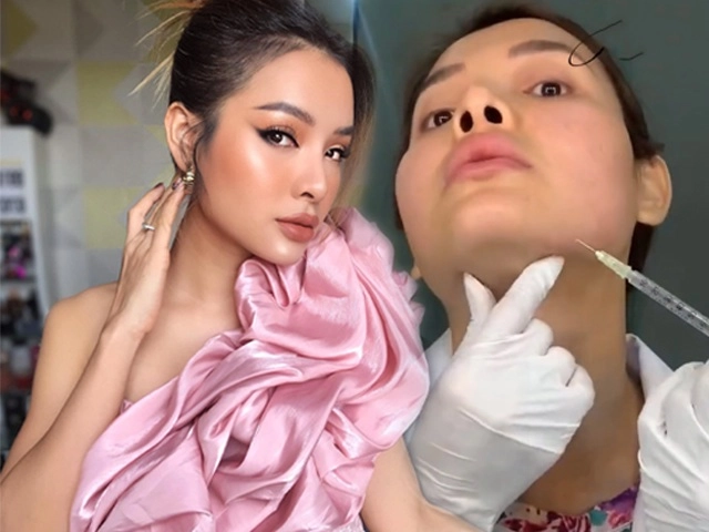 Huyền baby tiêm filler lên mũi cằm thon gọn hàm để trở nên hoàn mỹ - 20