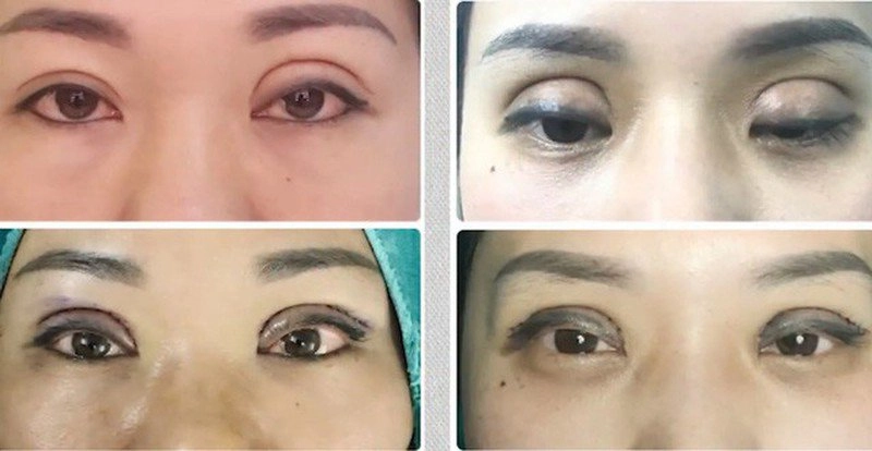 Những ca nhấn cắt mí thất bại nhất làm mạng xã hội bùng nổ - 7