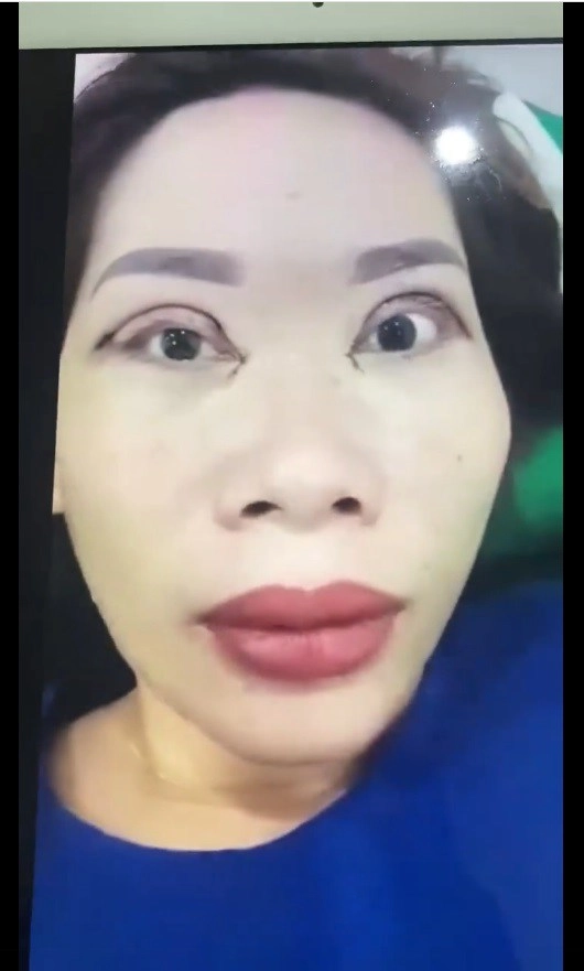 Những ca nhấn cắt mí thất bại nhất làm mạng xã hội bùng nổ - 11