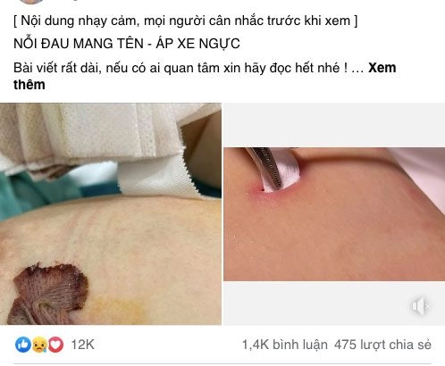 Trước khi cai sữa mặc con chắp tay xin hòa minzy phải mổ áp-xe ngực nổi cục như trứng gà - 1