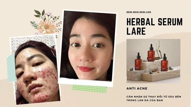 Bí quyết phục hồi làn da hư tổn do mụn cho chị em phụ nữ - 6
