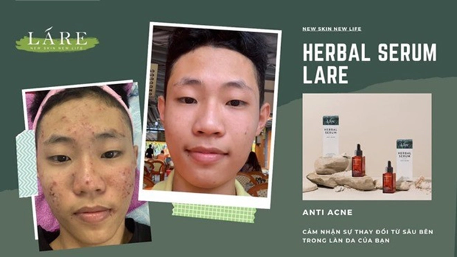 Bí quyết phục hồi làn da hư tổn do mụn cho chị em phụ nữ - 7