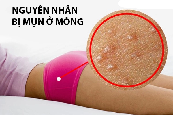 Cách trị mụn mông và thâm mông hiệu quả an toàn tại nhà - 1