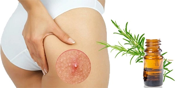 Cách trị mụn mông và thâm mông hiệu quả an toàn tại nhà - 2