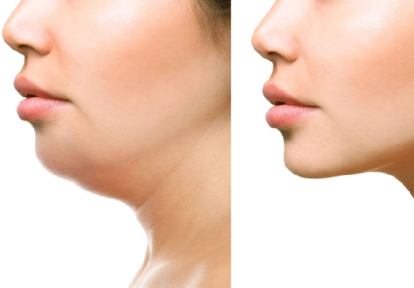 Cằm v line những cách tạo hình v line và chăm sóc hiệu quả - 7