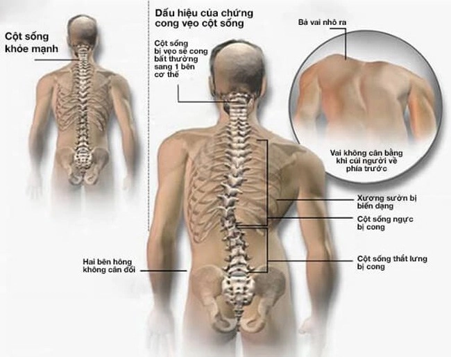 Đứng hay ngồi sai cách cũng làm dáng xiêu vẹo nàng chớ lo bởi tập gym có thể cải thiện - 2
