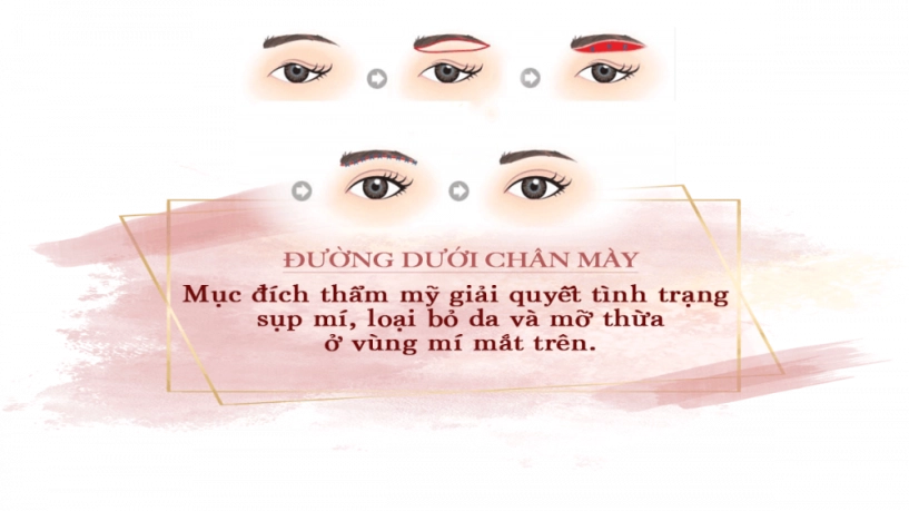 Treo cung chân mày là gì mà ai làm cũng trẻ ra chục tuổi - 3