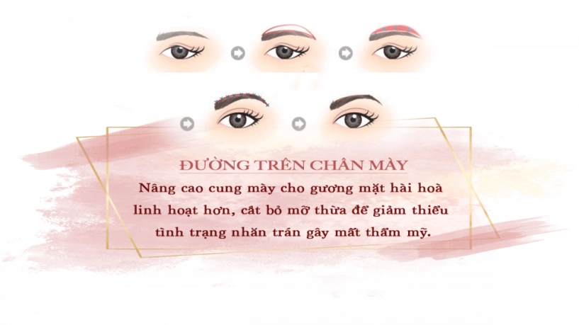 Treo cung chân mày là gì mà ai làm cũng trẻ ra chục tuổi - 4