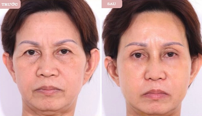 Treo cung chân mày là gì mà ai làm cũng trẻ ra chục tuổi - 6