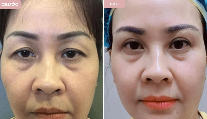 Treo cung chân mày là gì mà ai làm cũng trẻ ra chục tuổi - 7