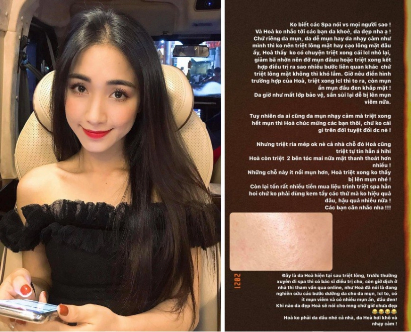 Triệt lông mặt ngờ đâu về nổi mụn hoà minzy review cực có tâm quá trình trị mụn tại gia - 3