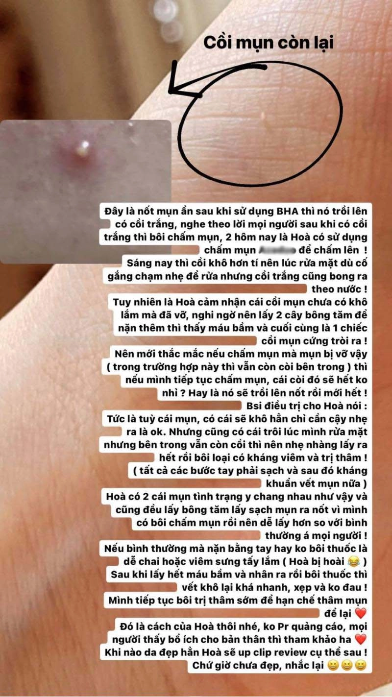 Triệt lông mặt ngờ đâu về nổi mụn hoà minzy review cực có tâm quá trình trị mụn tại gia - 4