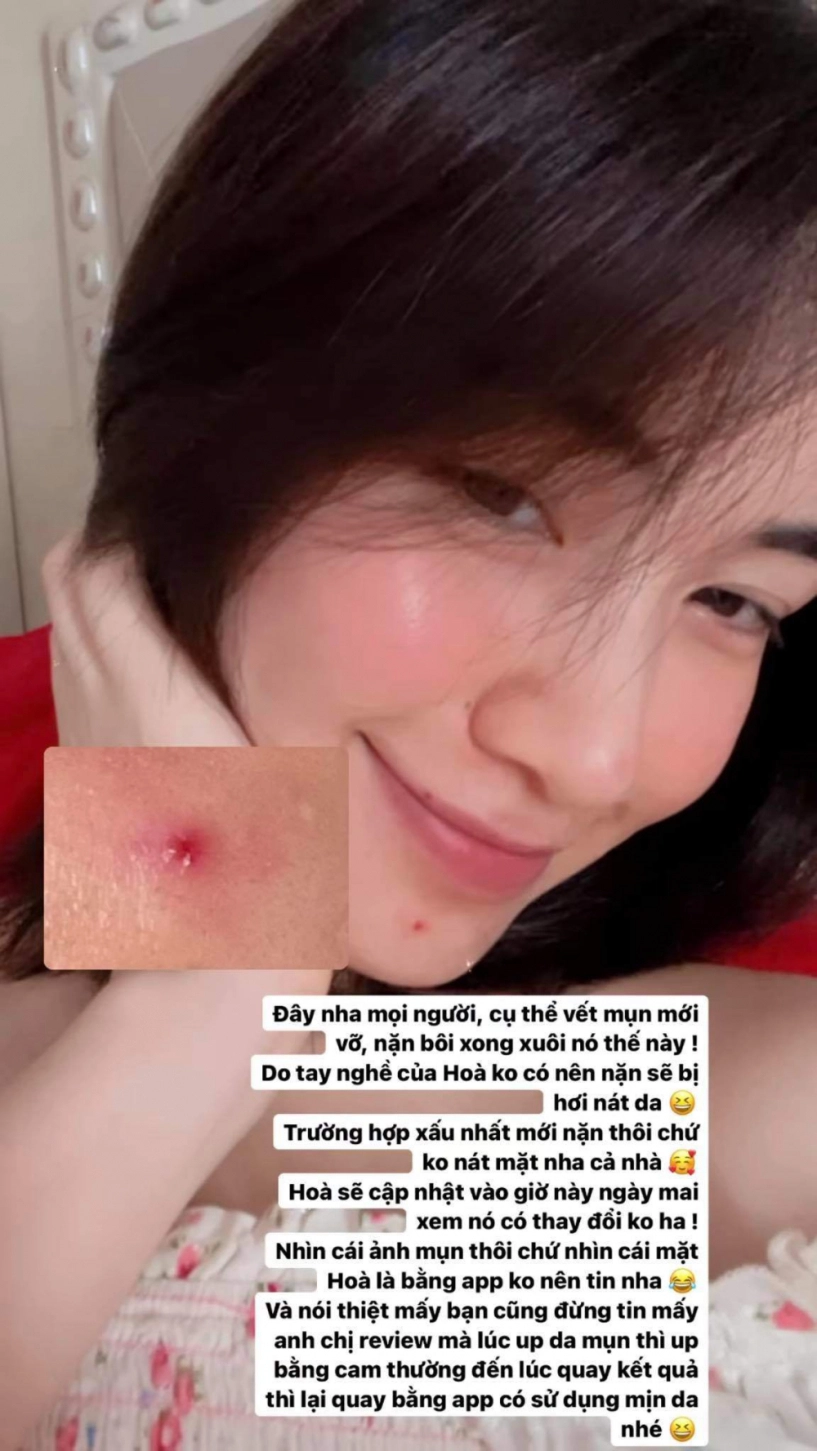 Triệt lông mặt ngờ đâu về nổi mụn hoà minzy review cực có tâm quá trình trị mụn tại gia - 5