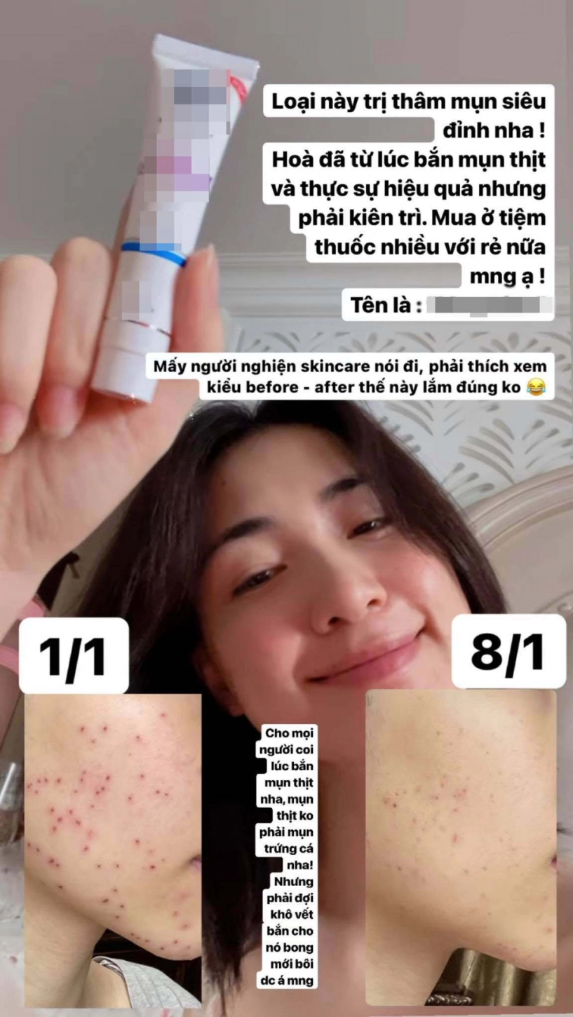Triệt lông mặt ngờ đâu về nổi mụn hoà minzy review cực có tâm quá trình trị mụn tại gia - 6