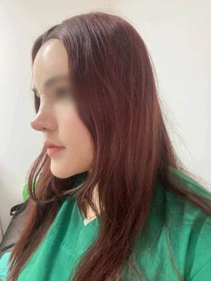 Ham chạy theo mốt mũi bay trung hoa chị em ngậm ngùi xin rút sụn - 4