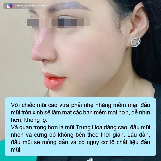 Ham chạy theo mốt mũi bay trung hoa chị em ngậm ngùi xin rút sụn - 8