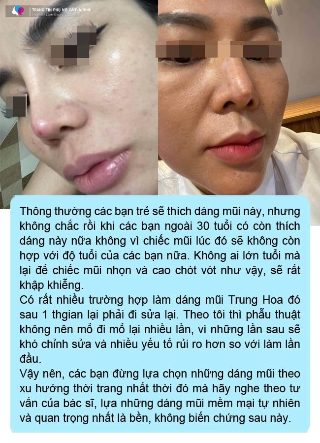 Ham chạy theo mốt mũi bay trung hoa chị em ngậm ngùi xin rút sụn - 9