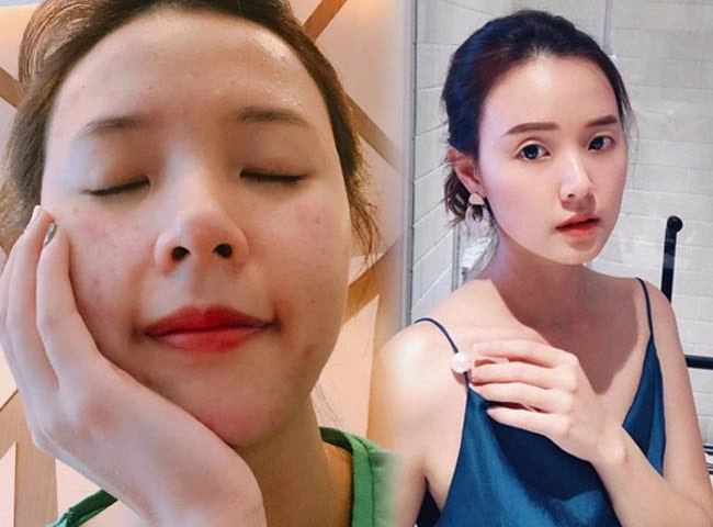 Mỹ nhân việt cũng khổ vì mặt mụn chi chít nàng bắt bệnh ngay để tết này da láng mịn - 2