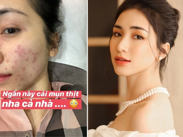 Mỹ nhân việt cũng khổ vì mặt mụn chi chít nàng bắt bệnh ngay để tết này da láng mịn - 3