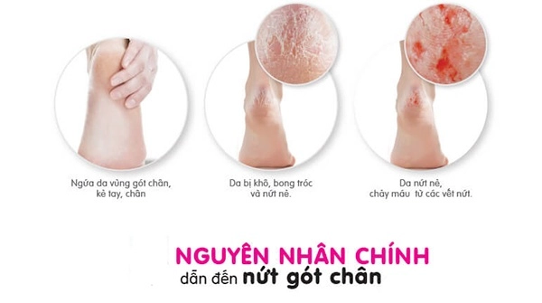 10 cách trị nứt gót chân tại nhà tự nhiên an toàn hiệu quả nhanh nhất - 1