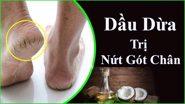 10 cách trị nứt gót chân tại nhà tự nhiên an toàn hiệu quả nhanh nhất - 3