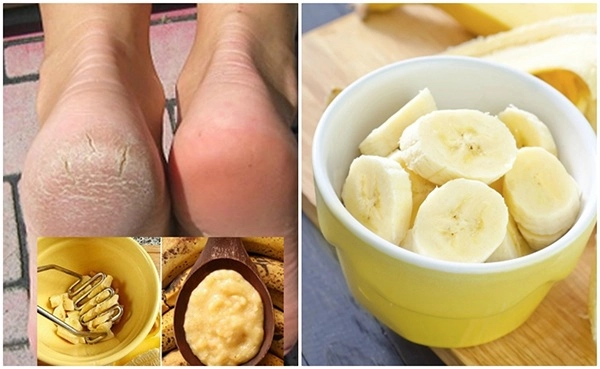 10 cách trị nứt gót chân tại nhà tự nhiên an toàn hiệu quả nhanh nhất - 10