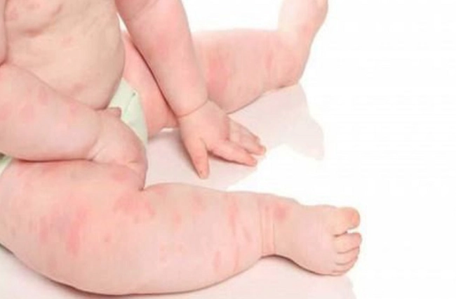 Bé bị nổi mẩn đỏ khắp người và ngứa là bị làm sao xử lý thế nào - 3