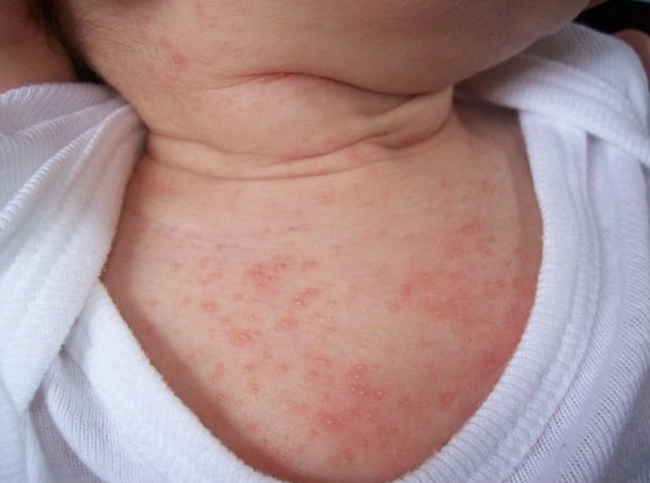 Bé bị nổi mẩn đỏ khắp người và ngứa là bị làm sao xử lý thế nào - 5