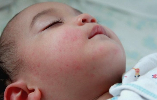 Bé bị nổi mẩn đỏ khắp người và ngứa là bị làm sao xử lý thế nào - 6
