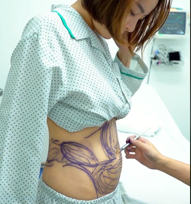 Hot girl trâm anh sau hút mỡ bụng tích cực khoe thân với đồ kiệm vải - 1