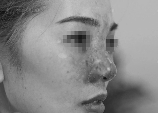 Muốn tiêm filler làm đẹp nàng nên nắm những lưu ý sau để tránh tiền mất tật mang - 4