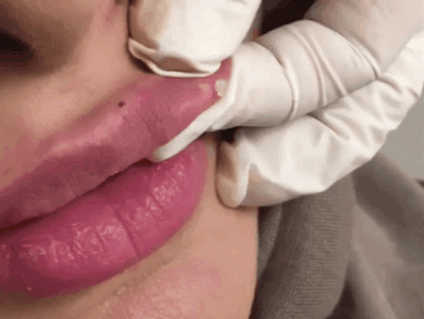 Muốn tiêm filler làm đẹp nàng nên nắm những lưu ý sau để tránh tiền mất tật mang - 6