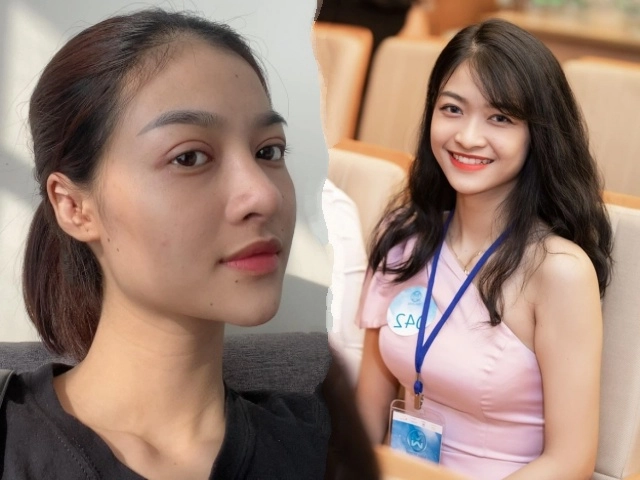 Muốn tiêm filler làm đẹp nàng nên nắm những lưu ý sau để tránh tiền mất tật mang - 9