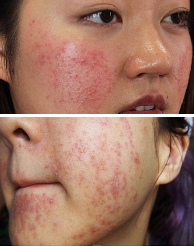 Rẻ-đẹp-dễ thực hư loại nước xông thải độc da bị nhiễm corticoid sao việt nhiều người áp dụng - 1