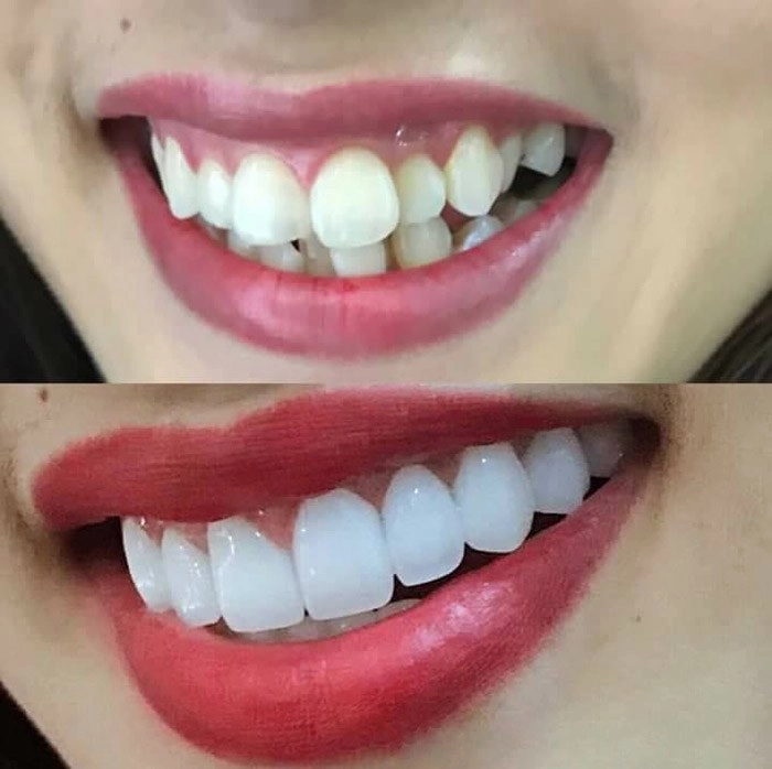 Bị hỏi địa chỉ làm mũi hoà minzy công khai luôn bộ phận đã sửa trên gương mặt - 6