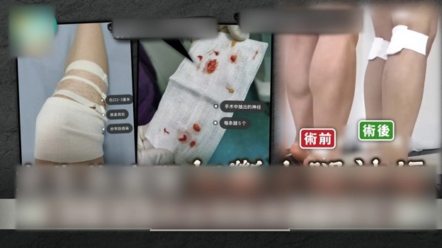 Cắt dây thần kinh để chân thon gọn xu hướng làm đẹp quái dị nhất của phái đẹp - 3