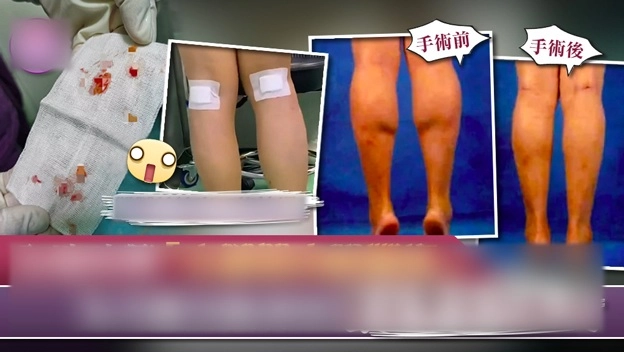 Cắt dây thần kinh để chân thon gọn xu hướng làm đẹp quái dị nhất của phái đẹp - 4