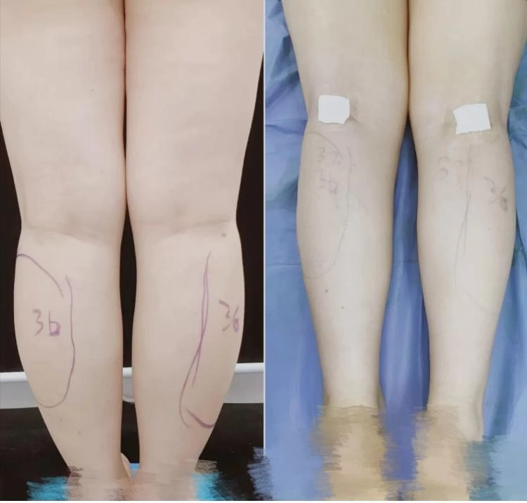 Cắt dây thần kinh để chân thon gọn xu hướng làm đẹp quái dị nhất của phái đẹp - 5