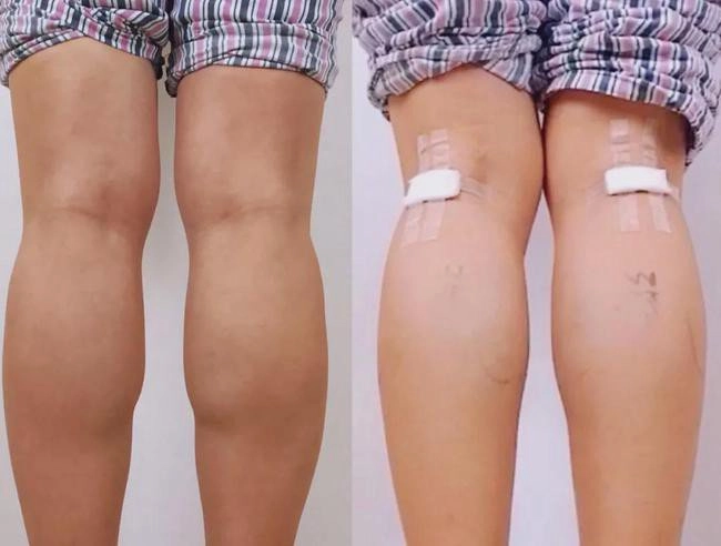 Cắt dây thần kinh để chân thon gọn xu hướng làm đẹp quái dị nhất của phái đẹp - 6