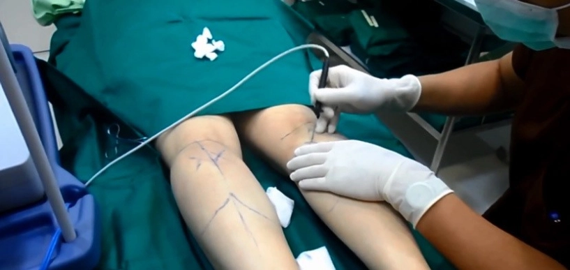 Cắt dây thần kinh để chân thon gọn xu hướng làm đẹp quái dị nhất của phái đẹp - 7
