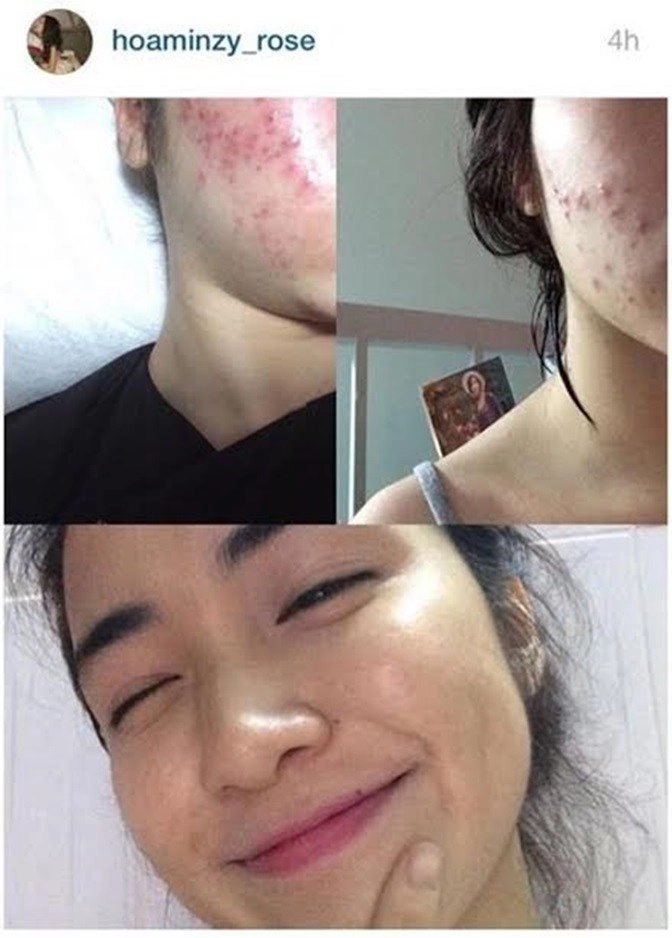 Hòa minzy khóc ròng khi mặt bong tróc từng mảng nhăn nheo như bà già - 1