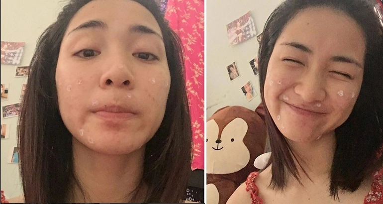 Hòa minzy khóc ròng khi mặt bong tróc từng mảng nhăn nheo như bà già - 2